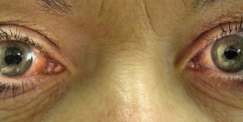 आखिर कैसे कम करें हाई कॉर्टिसोल ग्लूकोमा का खतरा?