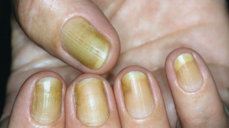 पीले पड़े नाखून को साफ करने में कारगर हैं घरेलू उपाय